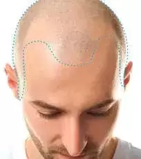 Depilacion-laser-Hombre-cabeza