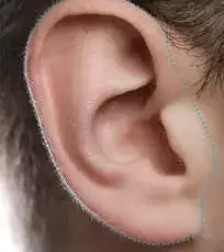 Depilacion-laser-Hombre-orejas